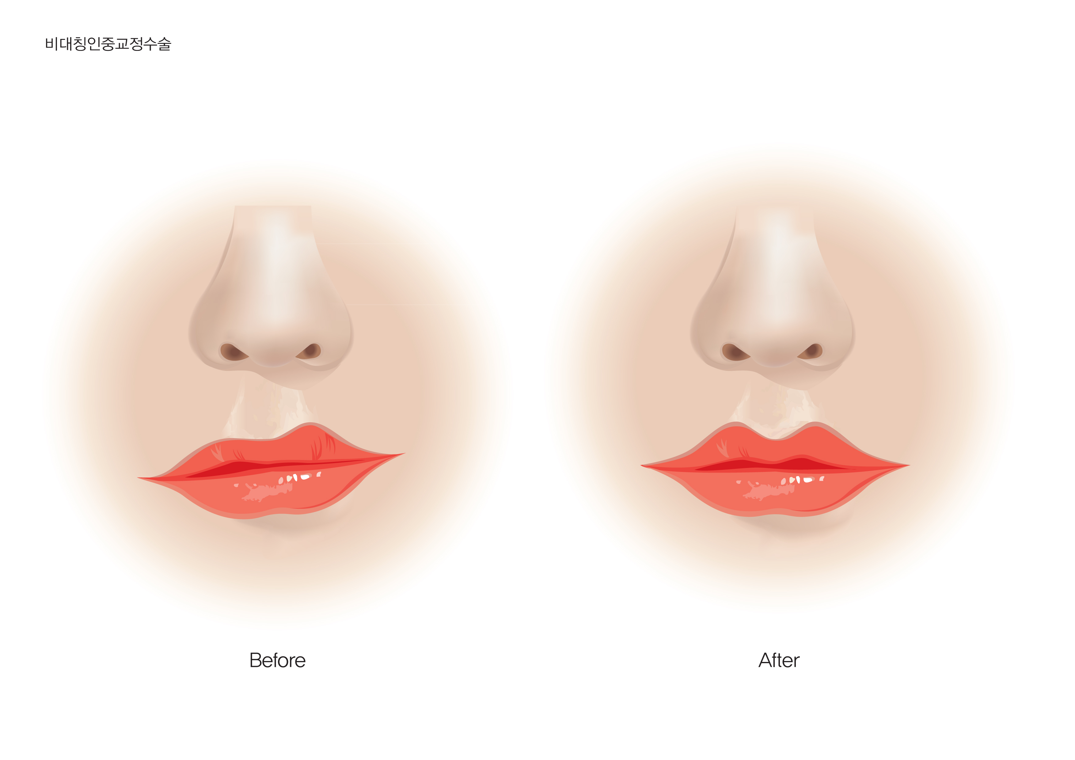 비대칭 인중 교정 일러스트